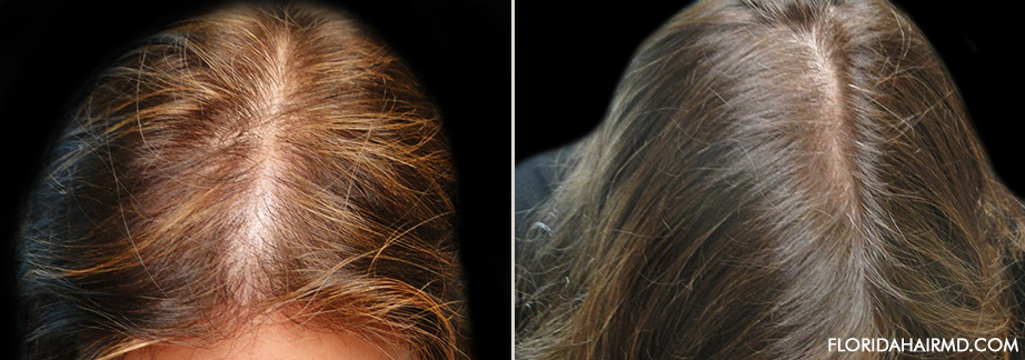 Before And After Stem Cell Hair Restoration