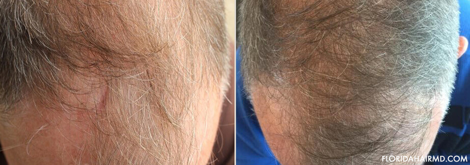 Hair Restoration Before And After