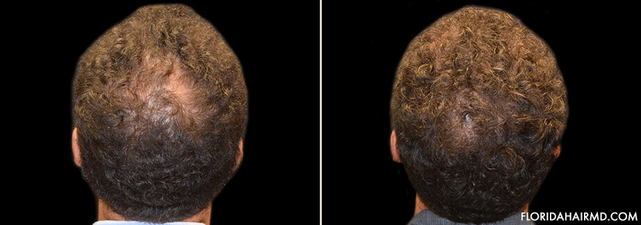 Results Of Hair Restoration Treatment