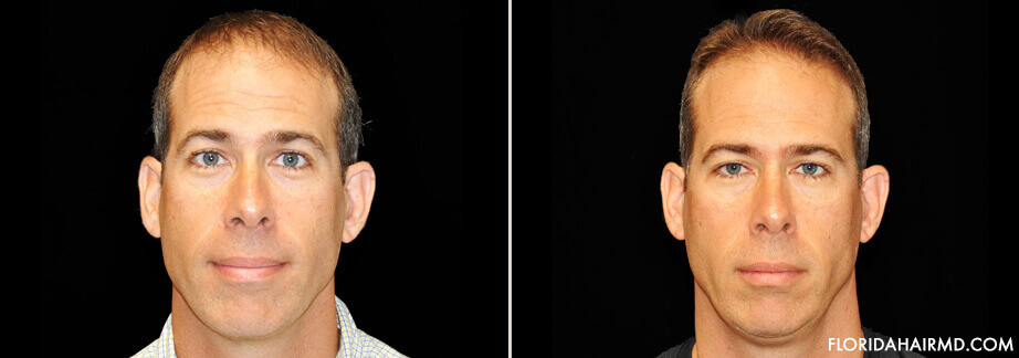 Hair Restoration Before And After