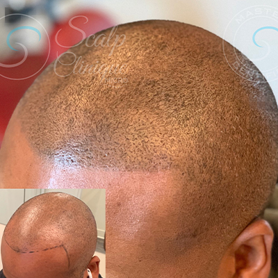 Scalp Micropigmentation Melbourne | SMP For Hair Loss