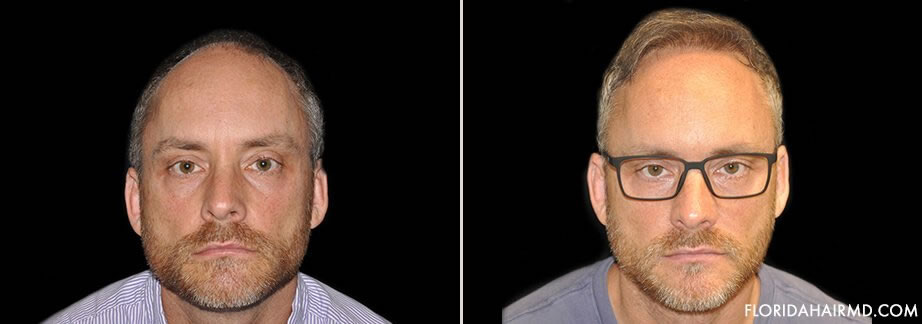 Hair Restoration Before And After