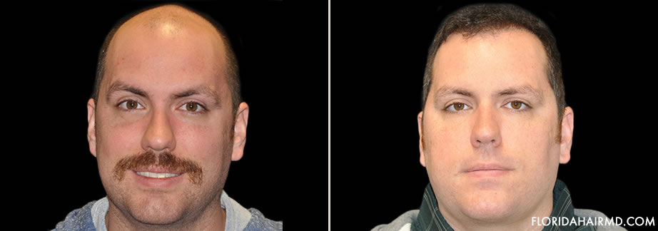 Hair Restoration Before & After In Florida