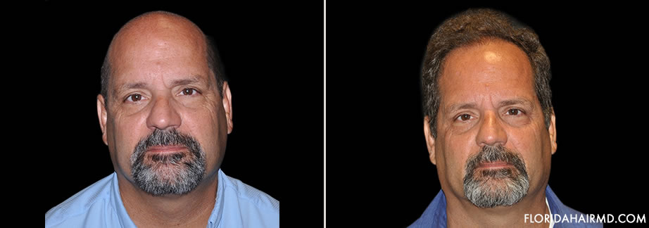 Hair Restoration Results In Florida