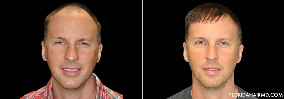 Before And After Hair Restoration In Florida