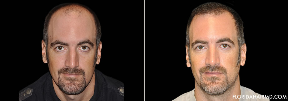 Before & After Hair Restoration In Florida