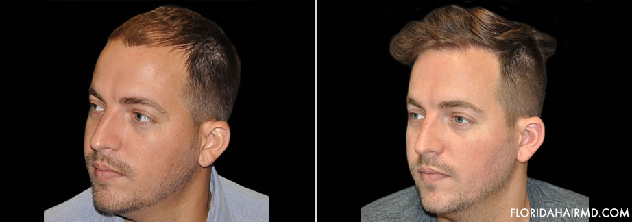 Before & After Hair Restoration Surgery