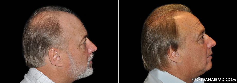 Hair Restoration Surgery Results In Florida