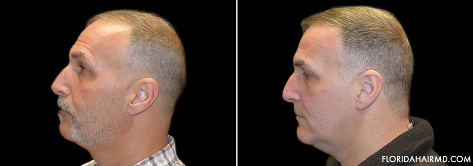 Before And After Hair Restoration Surgery In Flori