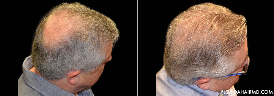 Before & After Hair Restoration Surgery In Florida