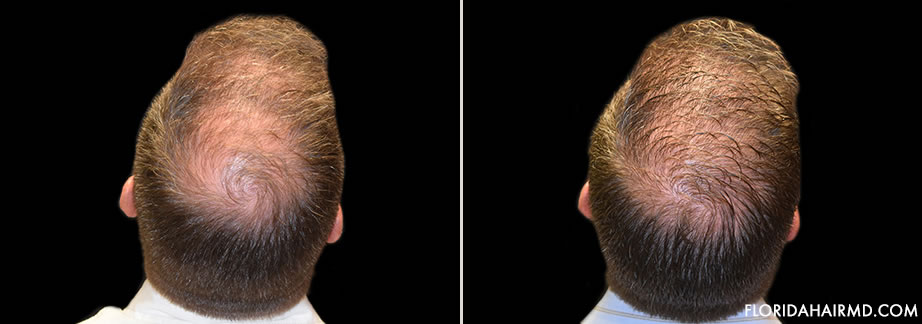 Hair Restoration Before And After Image