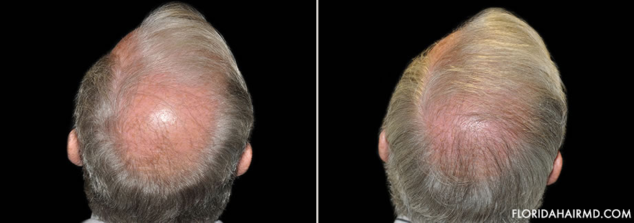 Image Of Hair Restoration Results