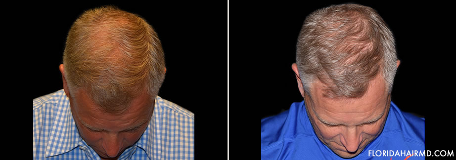 Before And After Image Of Hair Restoration