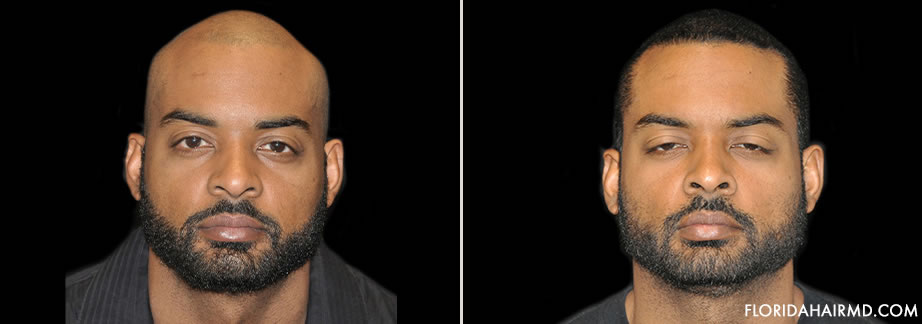 Before & After Image Of Hair Restoration