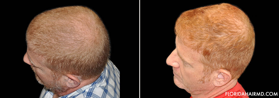 Hair Restoration Before And After Image In Florida