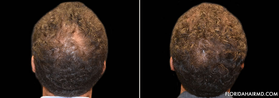 Hair Restoration Before & After Image In Florida