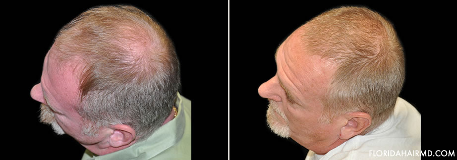 Hair Transplant Before and After Gallery | NeoGraft Hair Restoration Tampa