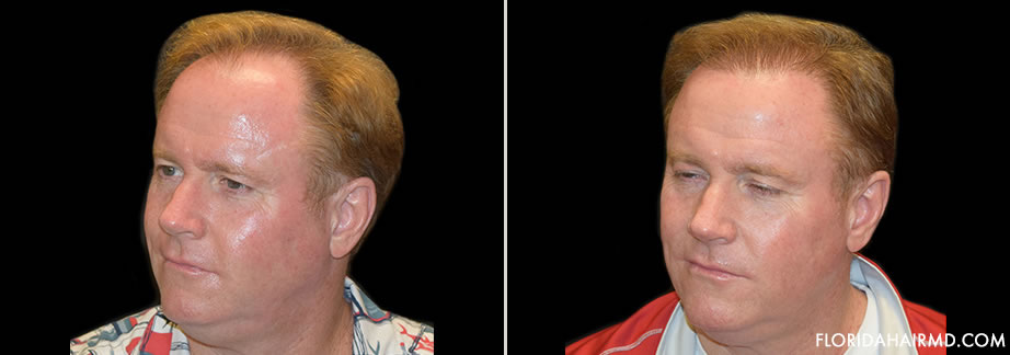 Before And After Image Of Hair Restoration In Flor