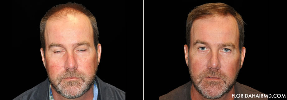 Before & After Image Of Hair Restoration In Florid