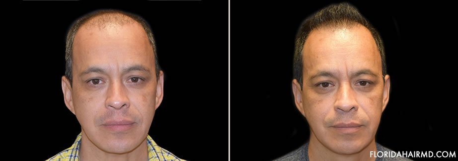 Hair Restoration Surgery Before And After Image