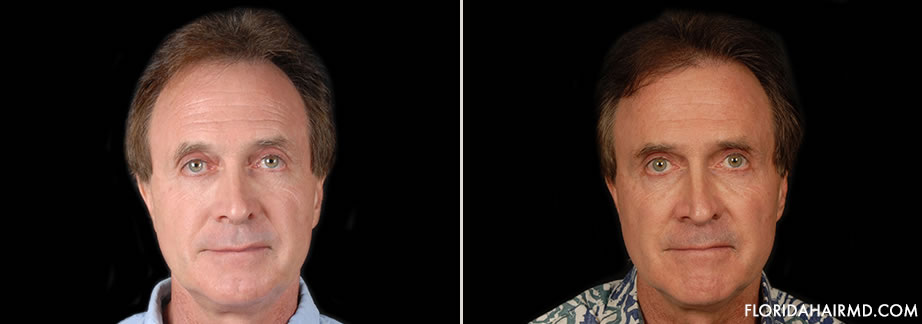 Hair Restoration Surgery Before & After Image