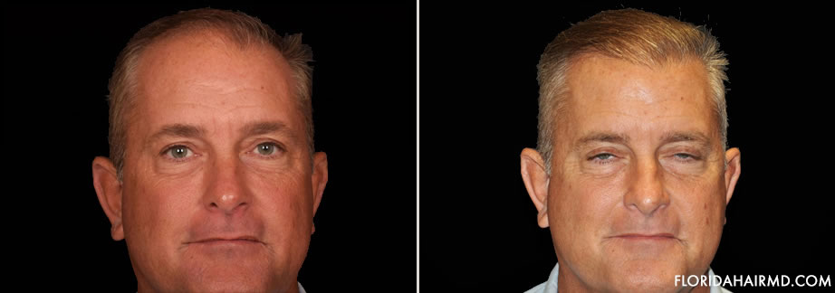 Image Of Hair Restoration Surgery Results