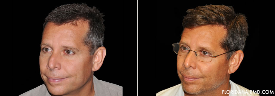 Before And After Image Of Hair Restoration Surgery