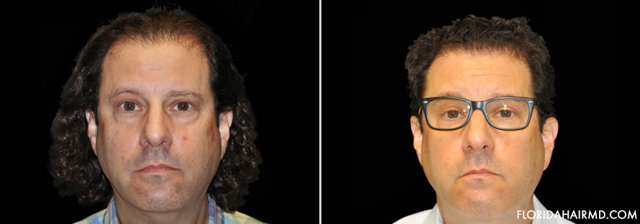 Before & After Image Of Hair Restoration Surgery