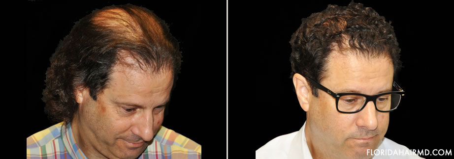 Hair Transplant Before and After Gallery | NeoGraft Hair Restoration