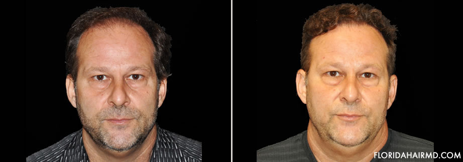 Before And After Image Of Hair Restoration Surgery