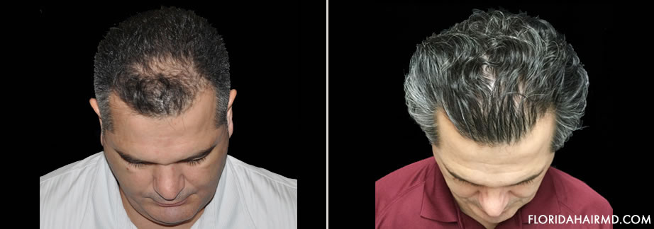 Before & After Image Of Hair Restoration Surgery I