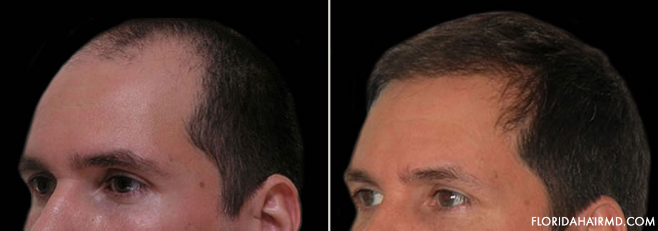 Photo Of Hair Restoration Results