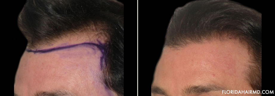 Before And After Photo Of Hair Restoration