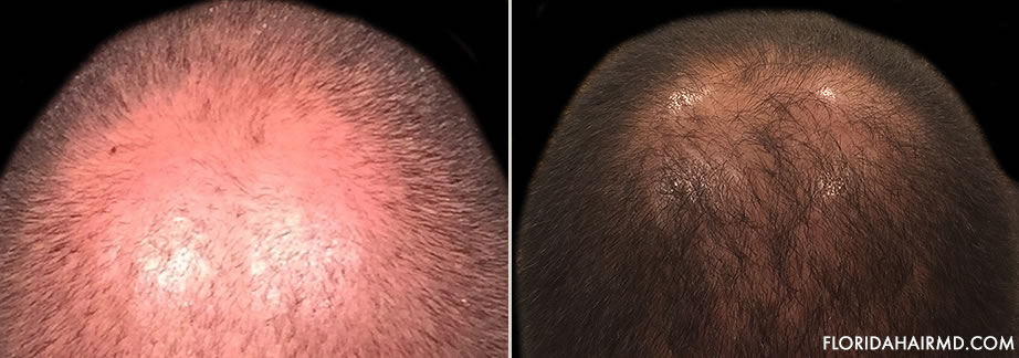 Before & After Photo Of Hair Restoration