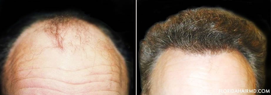 Hair Restoration Before And After Photo In Florida