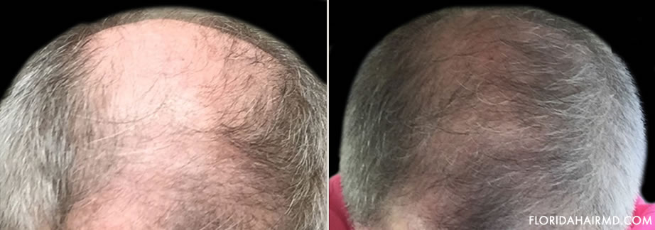 Hair Restoration Before & After Photo In Florida