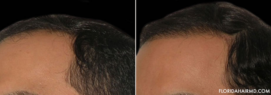 Before And After Photo Of Hair Restoration In Flor