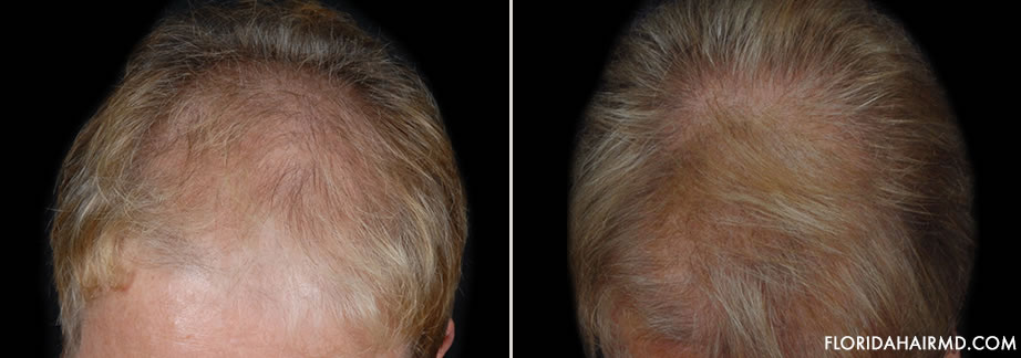 Hair Restoration Surgery Before And After Photo